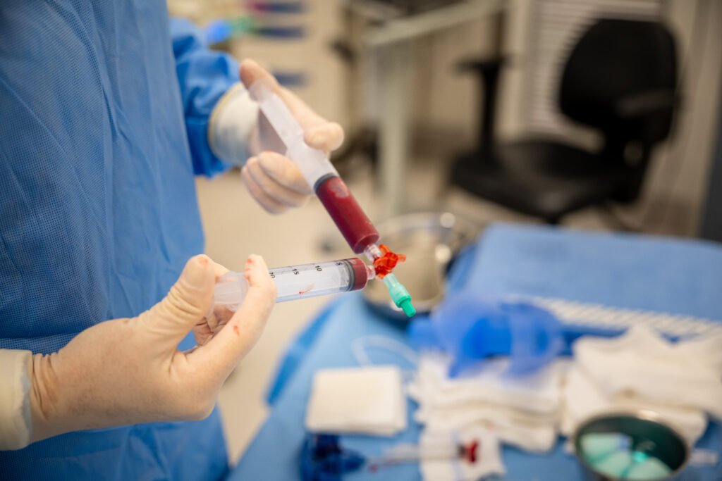Imagem médica da preparação do BMA (aspirado de medula óssea) para terapia regenerativa no joelho.